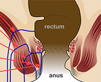 Fistula in Ano